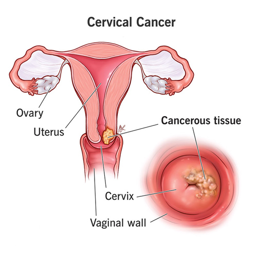 سرطان دهانه رحم (Cervical Cancer)